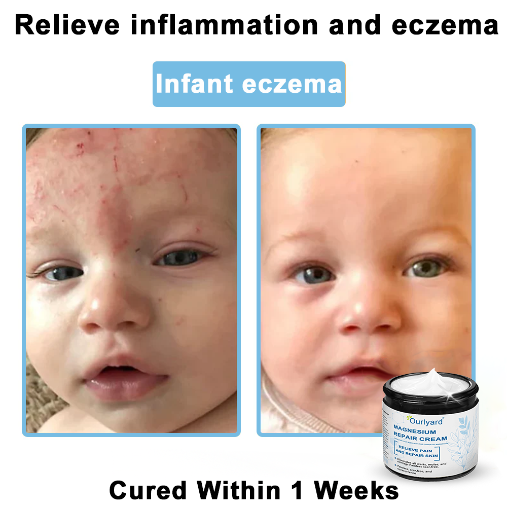 ✅Mayo Clinic Official: Magnesium skin repair cream (Eczema and Psoriasis Relief, Skin Repair, Even Tone, Acne and Dark Spot Treatment, Wart and Mole Removal)